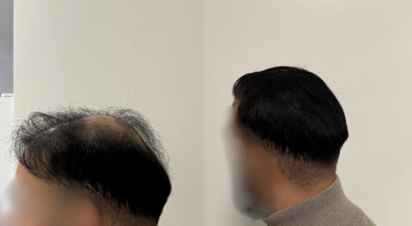 Nova™ Hairfillup Naturlig Utseende og Vannavstøtende Beskyttelse